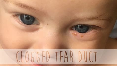clogged eye duct relief for babies
