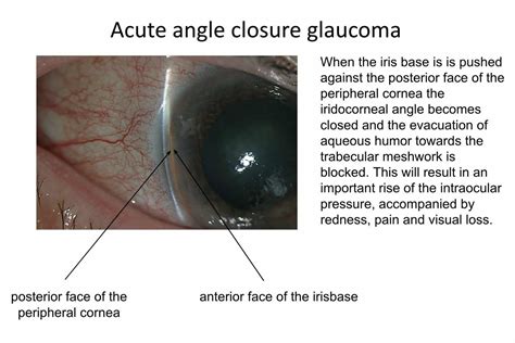 closed angle acute glaucoma causes