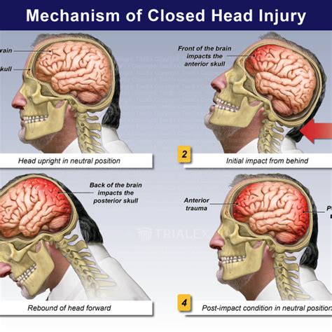 Closed Head Injury Symptoms Overview