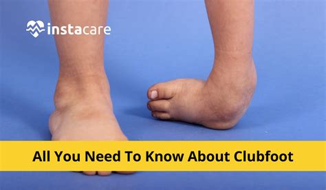 club foot causes