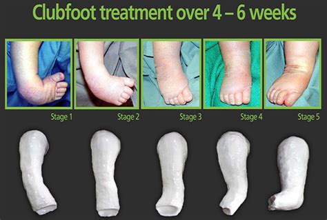 club foot prevention