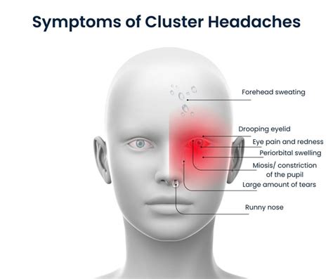 cluster headaches overview