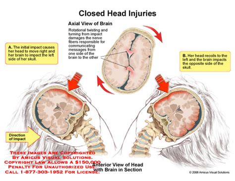 Cognitive Symptoms of Closed Head Injuries