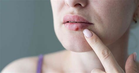 Cold sore complications