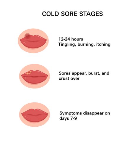 cold sore diagnosis