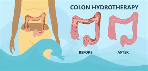 colon hydrotherapy benefits