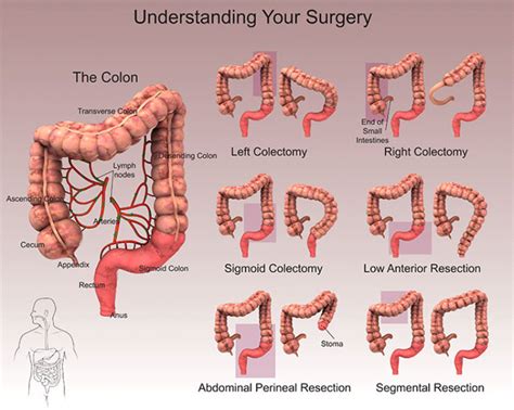 colon resection surgery