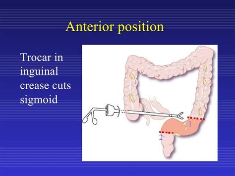 colon resection surgery for diverticulitis