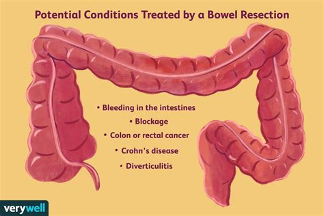 colon resection surgery for other conditions