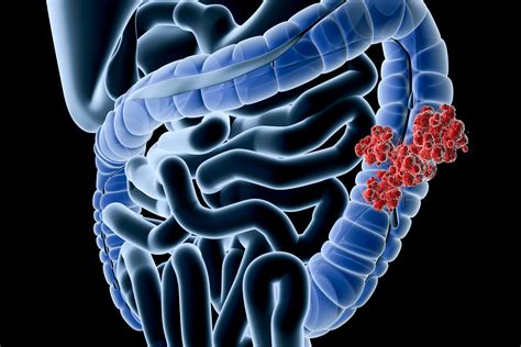 Colonoscopy cancer prevention