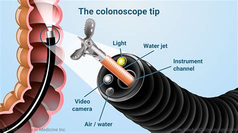 colonoscopy future