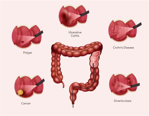 colonoscopy risks and complications