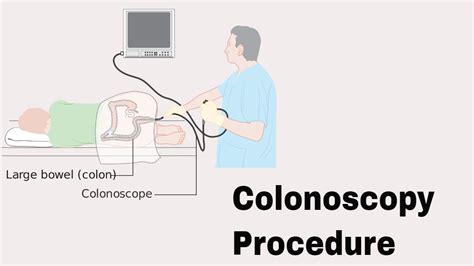 Steps to Prepare for a Colonoscopy