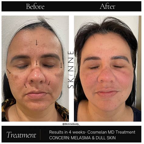 combining with other treatments