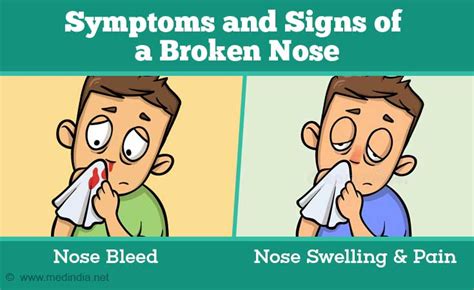 common broken nose symptoms