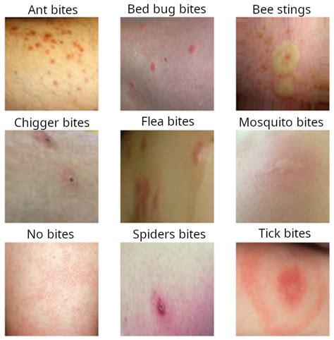 common bug bites