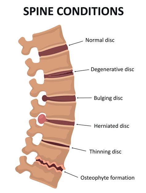 Common Lumbar Spine Conditions