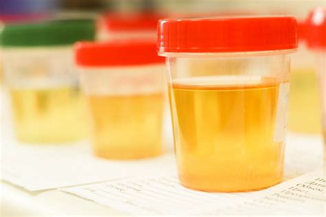 Common Urine Test Results