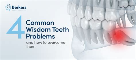Common issues associated with wisdom teeth