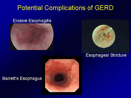 Complications of GERD in Babies