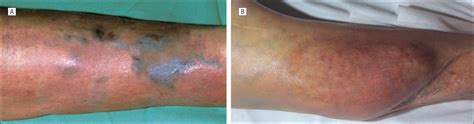 Complications of Hematomas