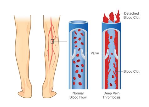 Complications of Leg Vein Thrombosis