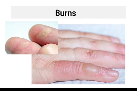 Complications of blisters on hands