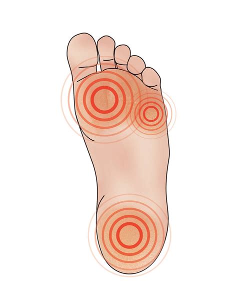 Complications of Untreated Calluses