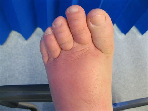 complications of cellulitis on feet