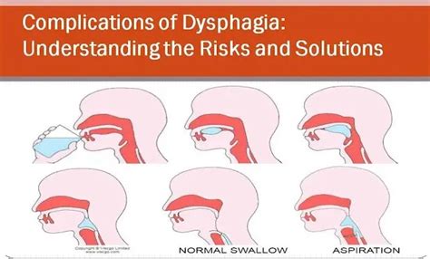 Complications of Dysphagia