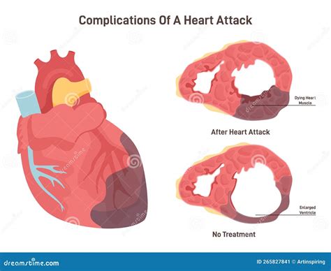 Complications Of Heart Attack