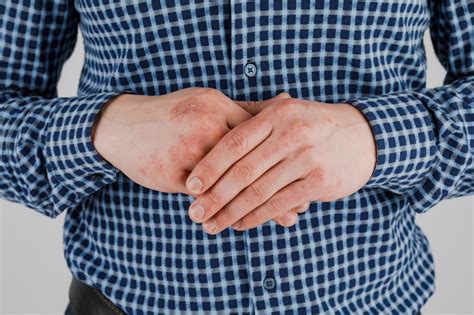 Complications of Herpes on Hand