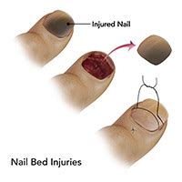 Complications of Injured Toenail Bed