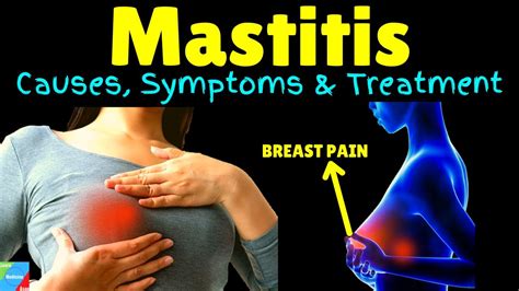 Complications of Mastitis Image