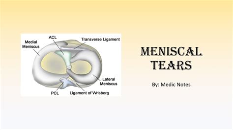 complications of meniscus tear