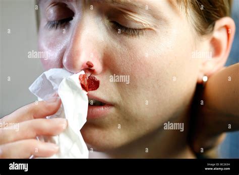 complications of nose hemorrhages