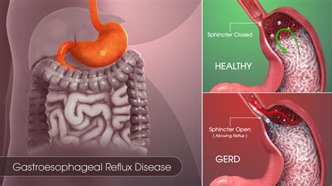 Complications of Reflux in Babies