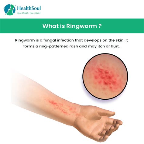 Complications of Ringworm