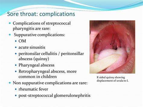 Complications of strep throat
