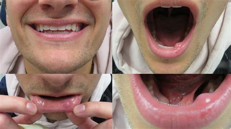 complications of untreated salivary gland blockages