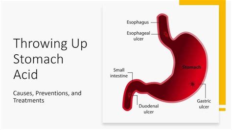 Complications of Untreated Vomiting Stomach Acid