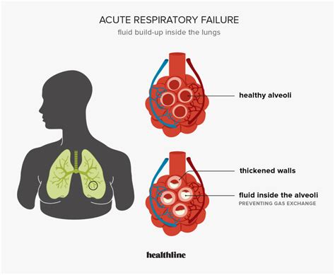 complications of respiratory failure
