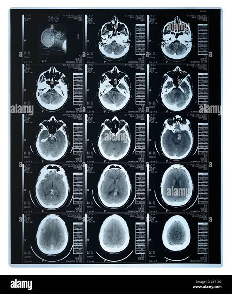 Computed Tomography Scan Results