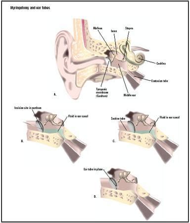 Conclusion and Next Steps for Myringotomy Ear Tube Surgery
