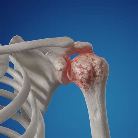 conclusion and next steps for shoulder arthritis