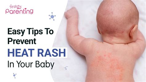 conclusion heat rash newborn