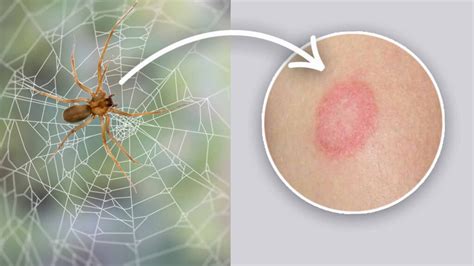 conclusion recluse spider bite