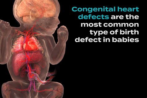 Congenital Heart Defects