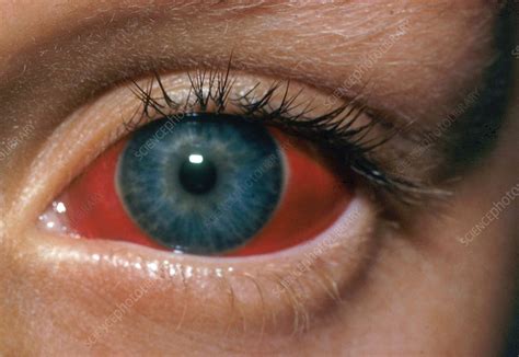 Conjunctival Hemorrhage