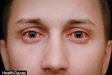 Conjunctivitis as a New Covid Symptom